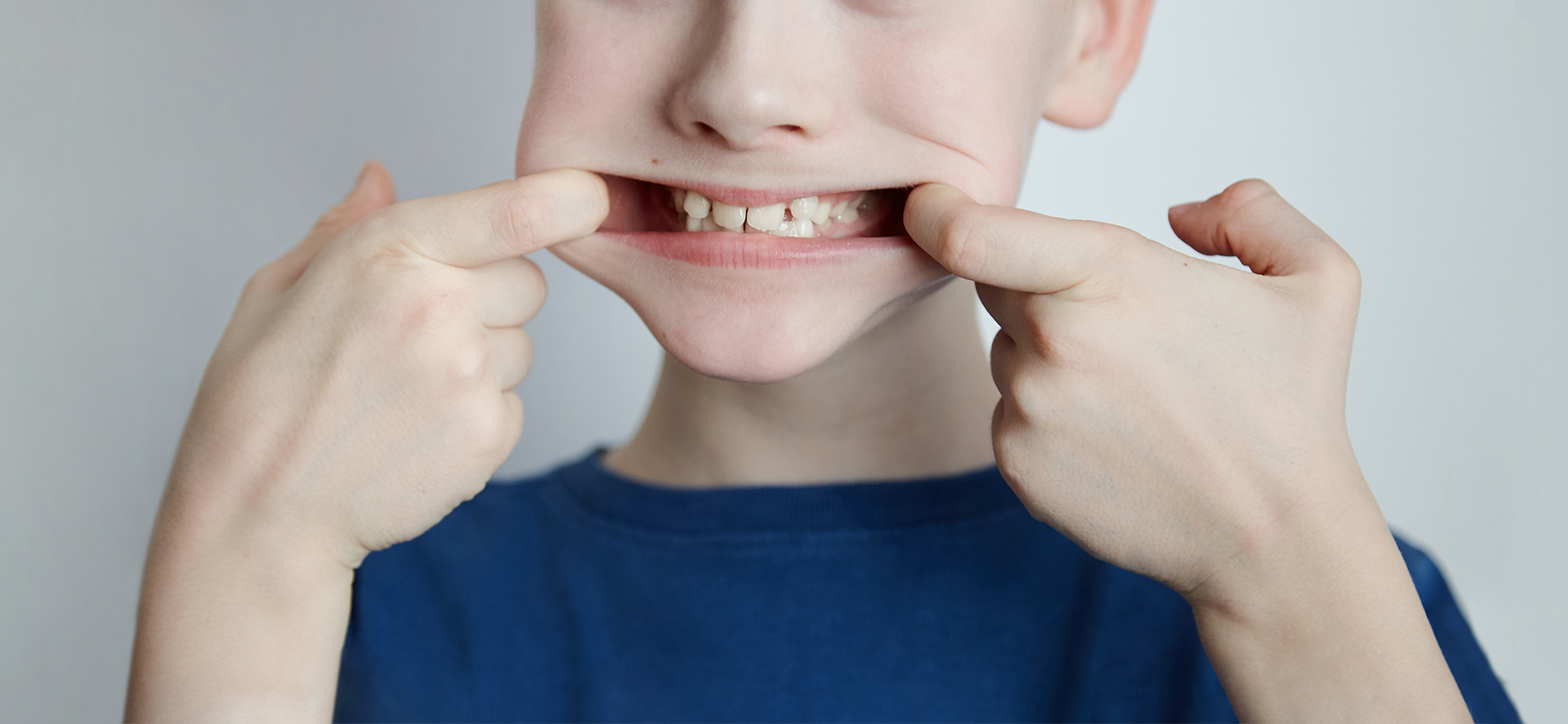 Что такое герметизация фиссур и как она защищает детские зубы от кариеса