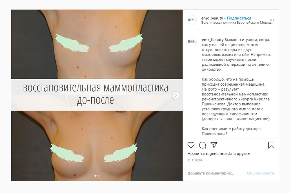 Пример маммопластики. Хирург восстановил молочную железу с помощью импланта и липофилинга — это процедура, когда у пациента берут его собственную жировую ткань и используют для коррекции другой части тела. Источник: emc_beauty / Instagram