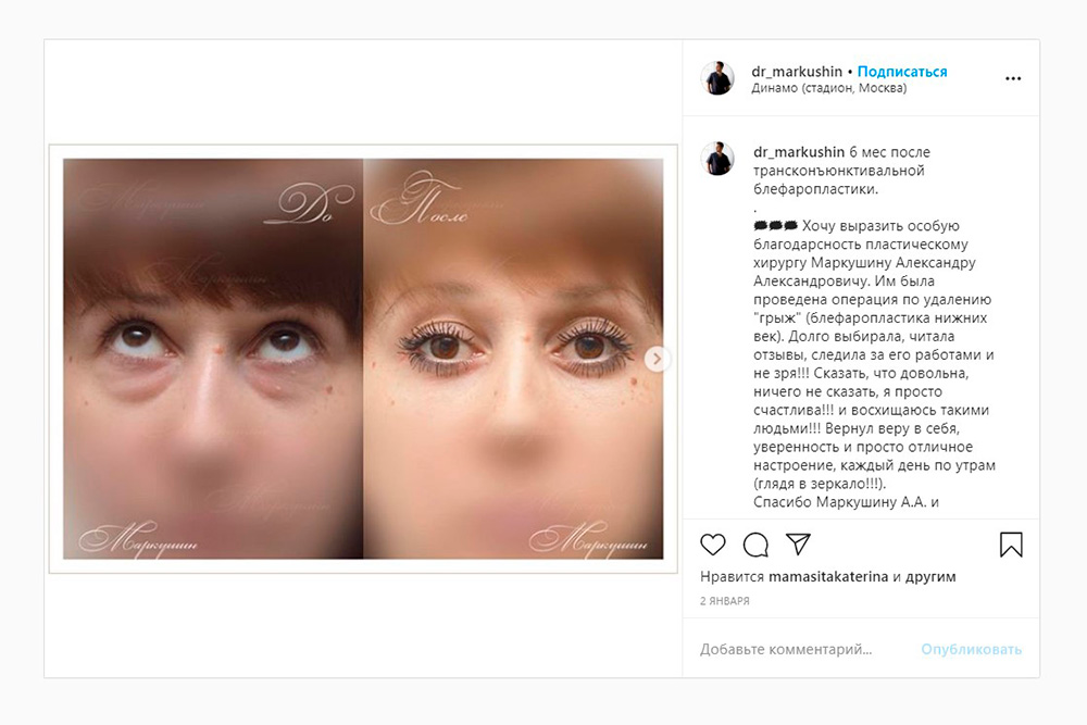 Пример блефаропластики нижних век. Хирург удалял жировые мешки под глазами. Источник: dr_markushin / Instagram