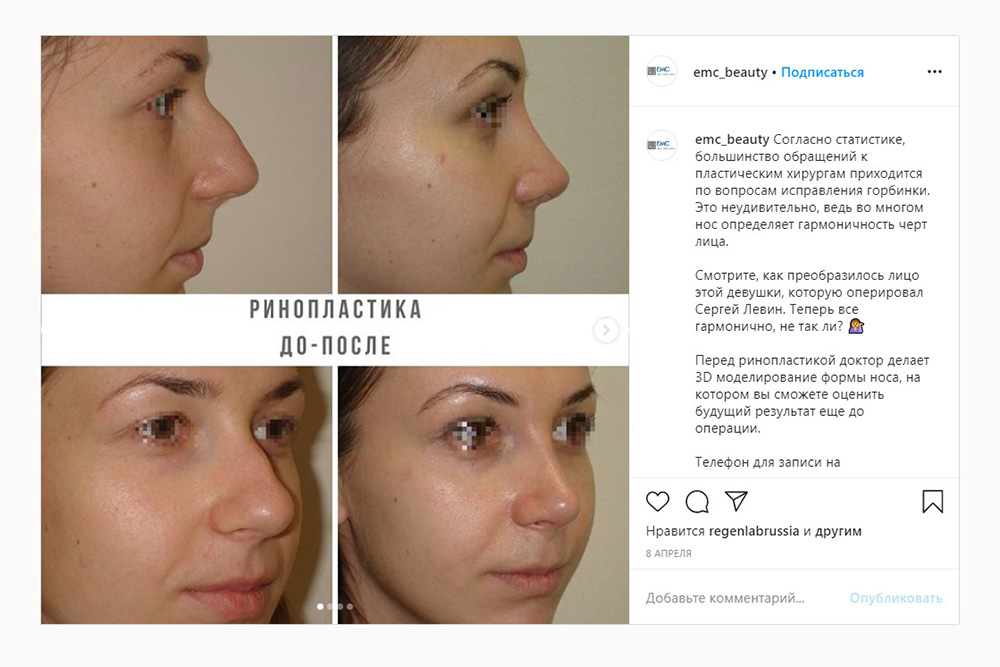 Пример ринопластики с исправлением горбинки носа. Источник: emc_beauty / Instagram