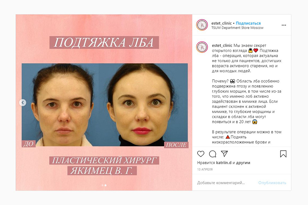 Вот так выглядит пациентка, которой сделали подтяжку лба. Источник: estet_clinic / Instagram
