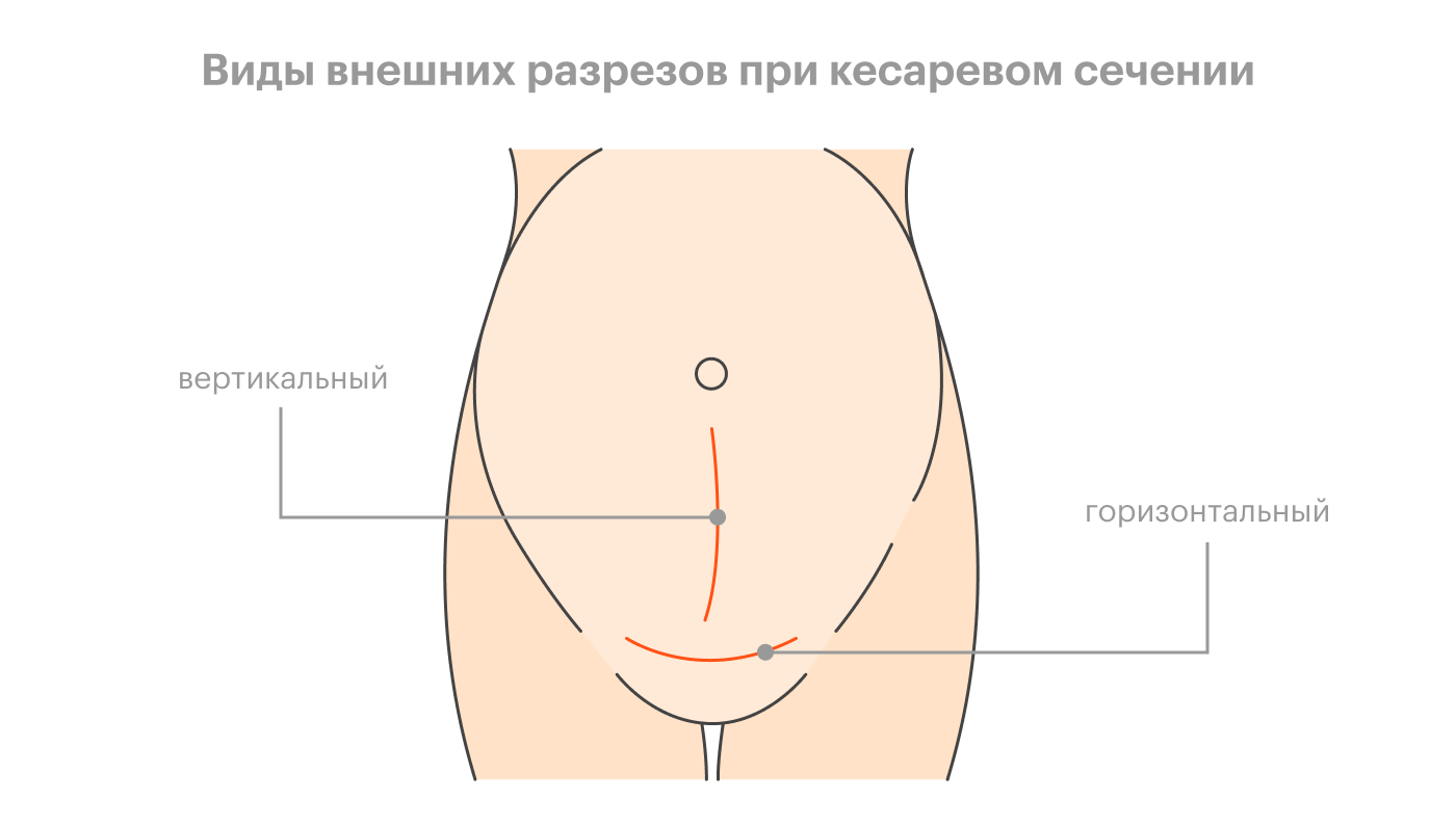 Горизонтальный разрез при кесаревом сечении лучше как минимум с косметической точки зрения: его можно спрятать под нижним бельем