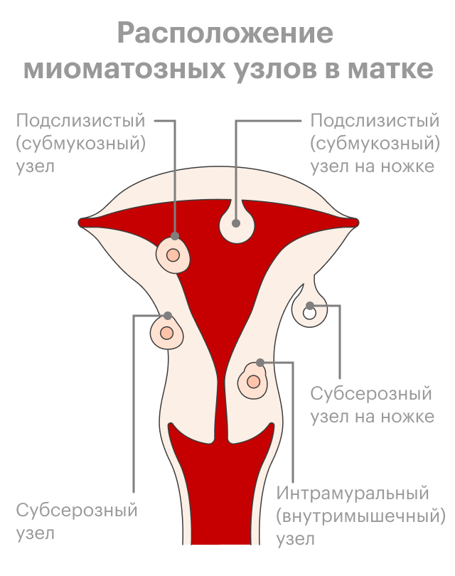 Миоматозные узлы классификация