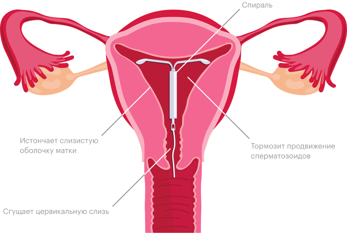 Фото Спирали Против Беременности В Матке