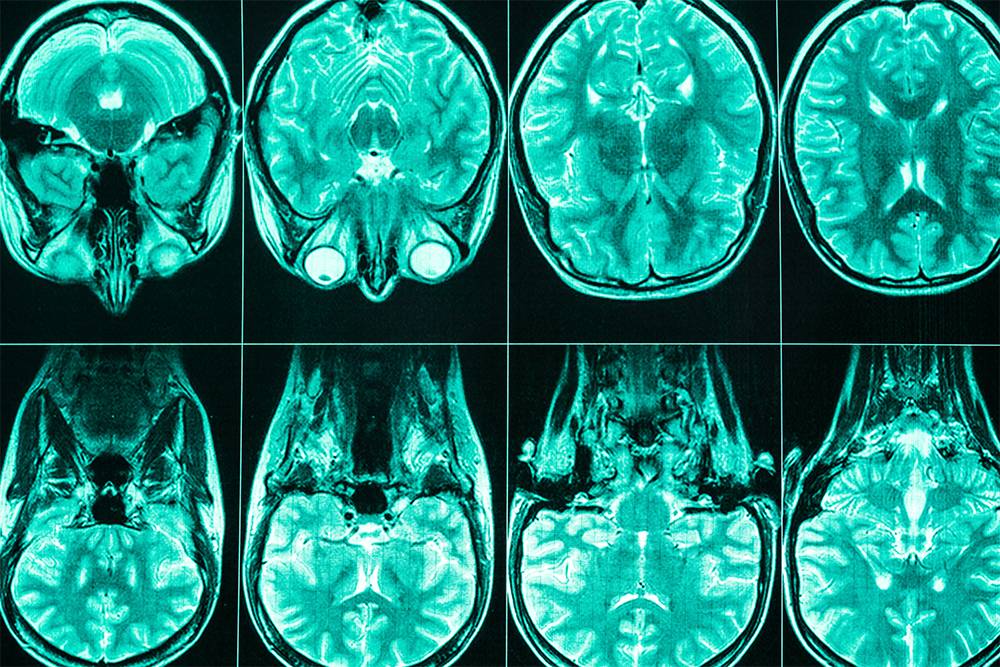 Магнитно-резонансная томография позволяет детально изучить мягкие ткани организма. Но делать ее без&nbsp;показаний не стоит. Источник: Jalisko / Shutterstock