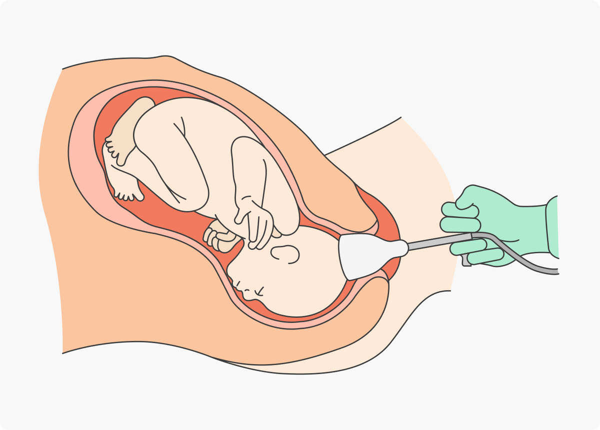 Вакуум не слишком часто используют в России. Его могут применять на втором этапе родов, если плоду внутриутробно не хватает воздуха — это наиболее быстрый способ извлечь его и спасти. Фото: blog.pregistry.com