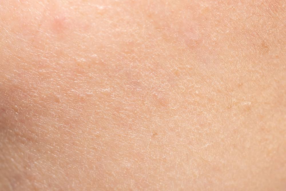 При&nbsp;обезвоженности кожа на ощупь может быть более шершавой, появляется чувство покалывания и стянутости