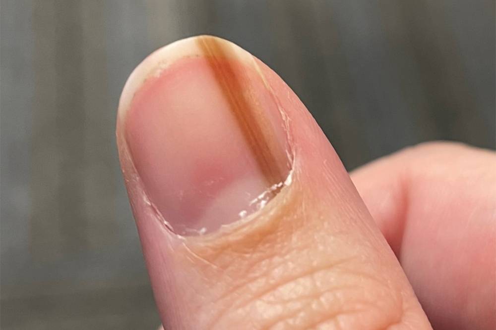 Так может выглядеть меланома под&nbsp;ногтевой пластиной. Источник: today.com