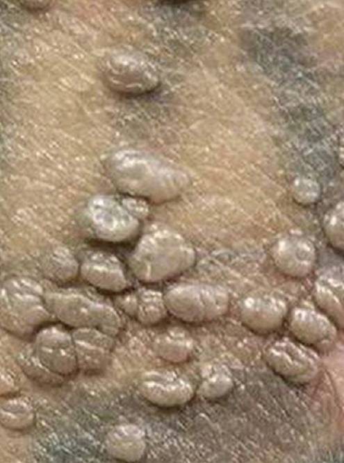 Татуировка, инфицированная контагиозным моллюском. Источник: ijam-web.org
