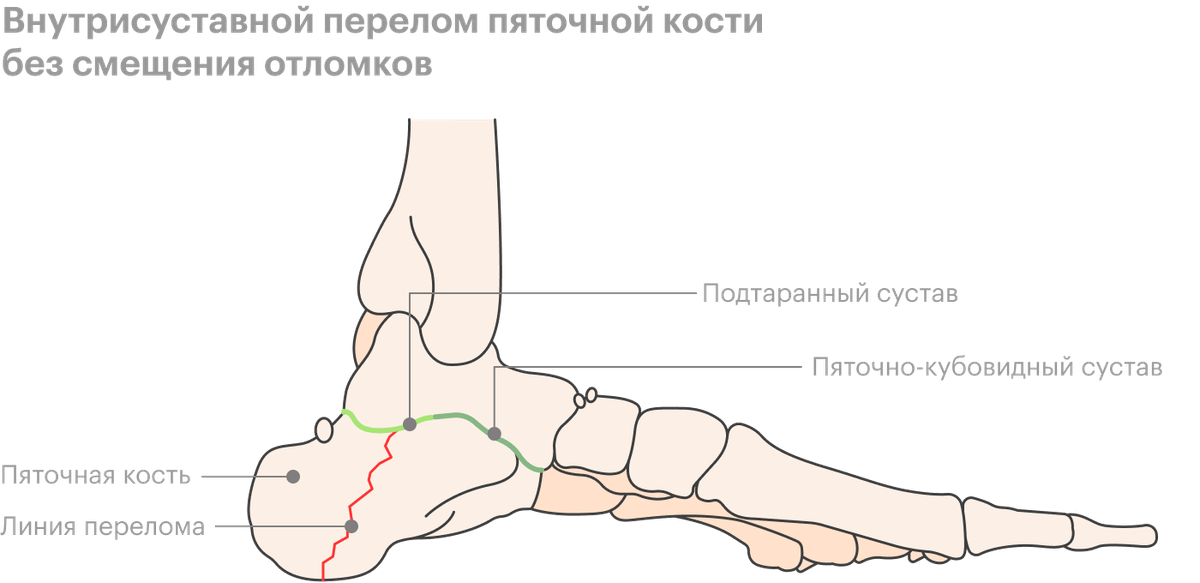 Фото Перебинтованной Ноги