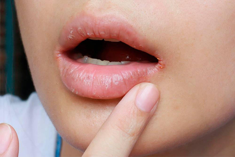 Хейлит — трещины и сухость в уголках губ. Источник: Wonderplay&nbsp;/ Shutterstock