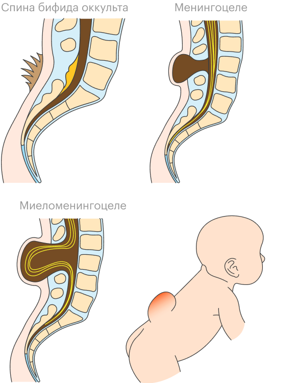 Так выглядят три самых распространенных формы спина бифида. Видно, как в зависимости от степени расщепления позвоночника спинной мозг и нервы развиваются внутри или вне&nbsp;тела — на наружной части спины