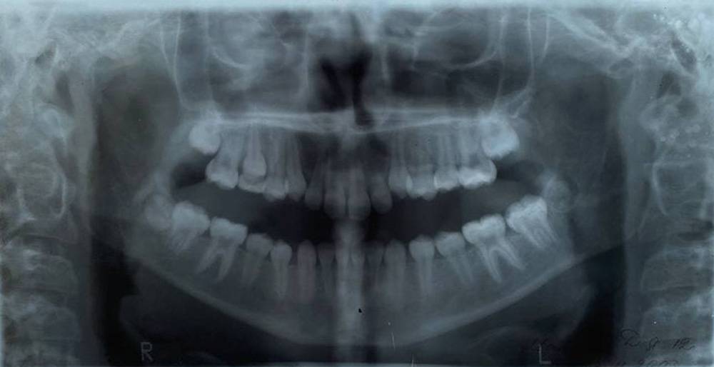 Это мои зубы в 12&nbsp;лет. По снимку можно заметить, что нижняя челюсть гораздо крупнее верхней