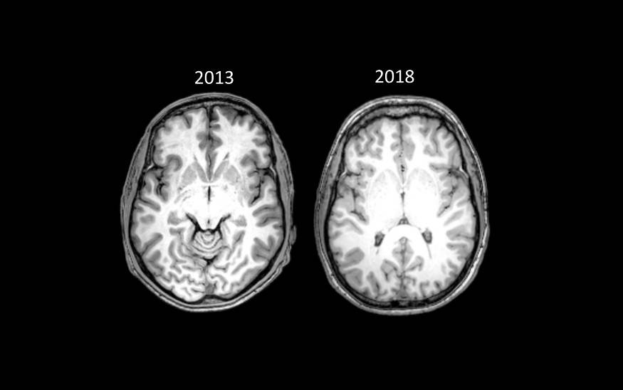 Сканы мозга Брайана Пенни: слева — первый, сделанный в 2013&nbsp;году, справа — повторный, сделанный в 2018&nbsp;году. На них видно переднюю комиссуру мозга — анатомическую структуру, на которую ученые ориентируются, когда сравнивают один скан с другим. Источник: Medium