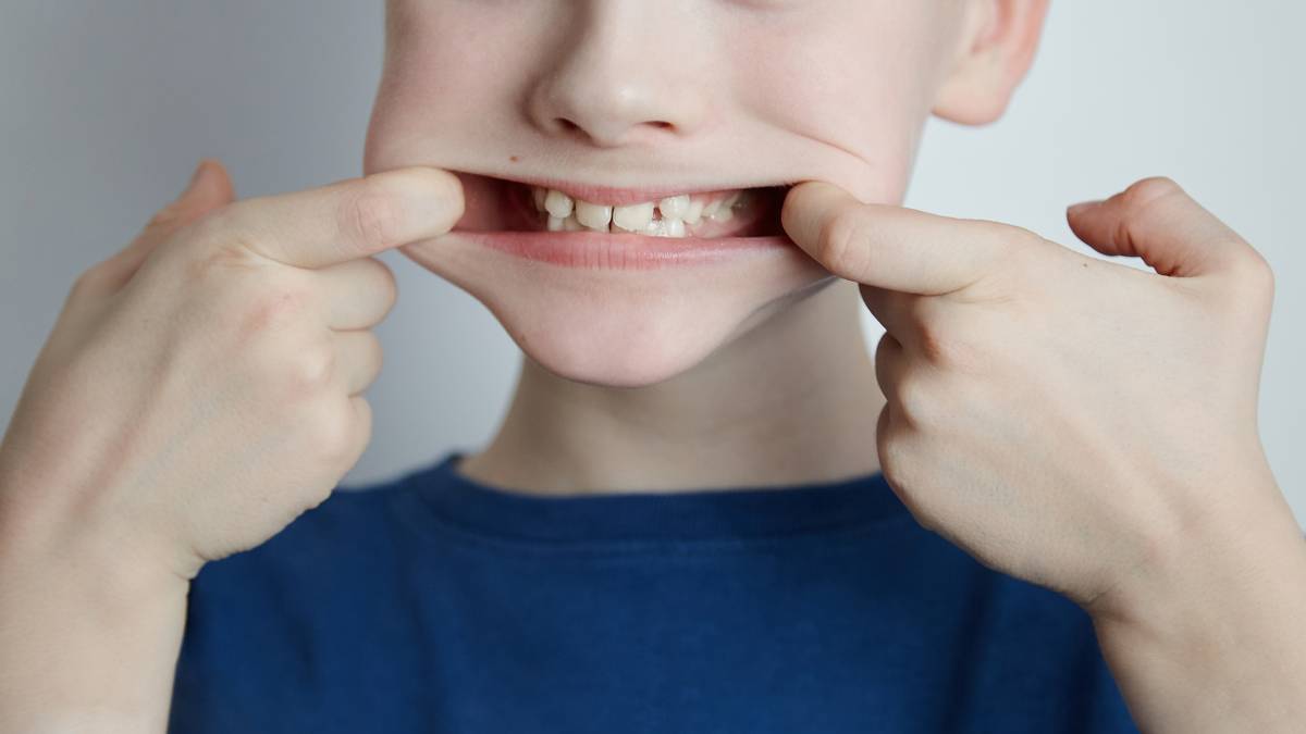 Что такое герметизация фиссур и как она защищает детские зубы от кариеса