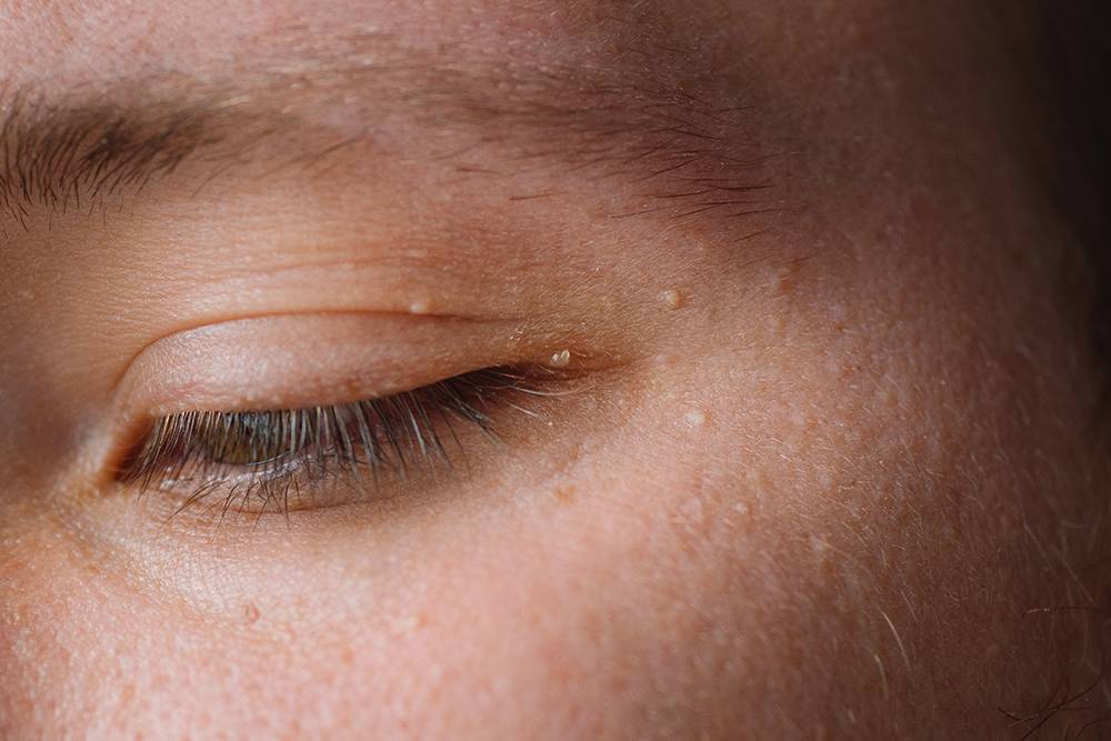 Милиумы — твердые уплотнения, которые чаще всего возникают в зоне вокруг глаз. Источник: Nastyaofly&nbsp;/ Shutterstock