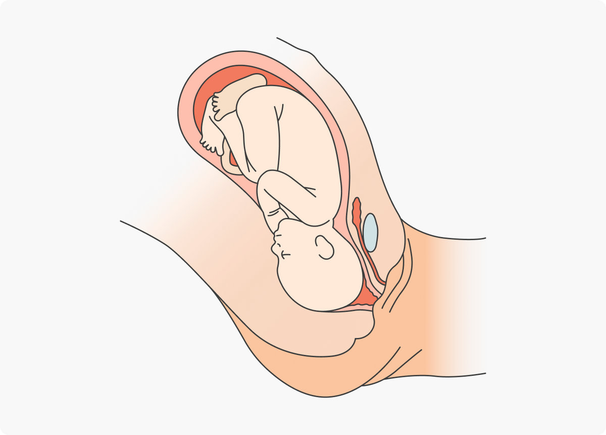 После 36-й недели ребенок занимает положение в матке, которое сохранится до родов. Правильное положение ребенка перед родами такое: ягодицы направлены вверх, головка — вниз, подбородок упирается в грудь. Это облегчает его продвижение во время родов