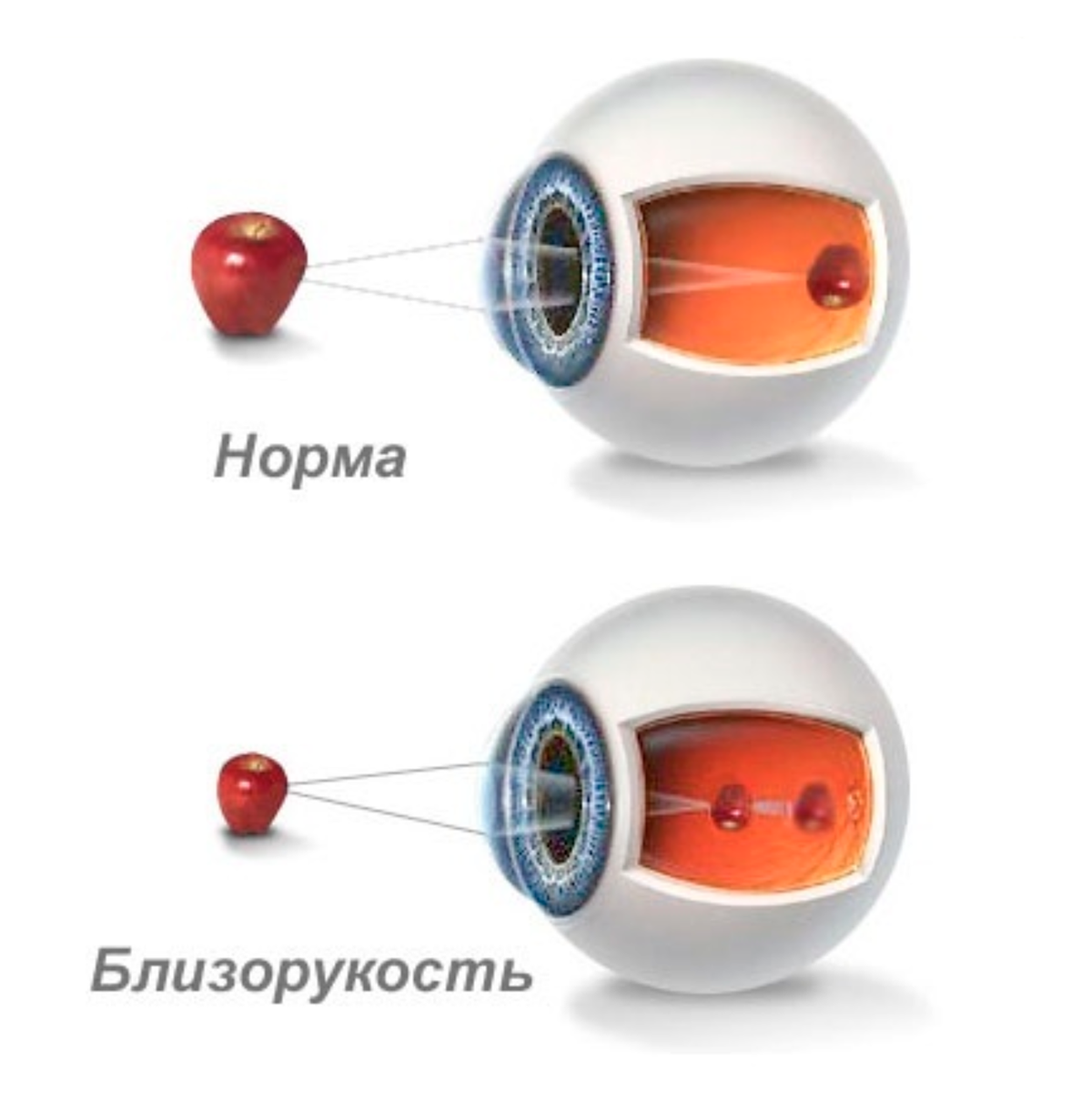 Установите соответствие изображение фокусируется перед сетчаткой признак