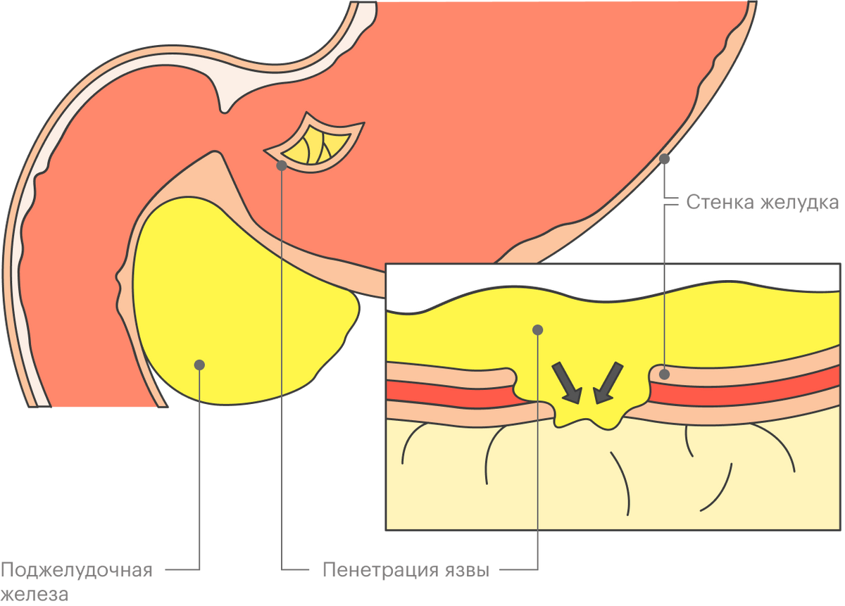 При&nbsp;пенетрации язвы желудка кислота начинается просачиваться в соседний орган, обычно поджелудочную железу