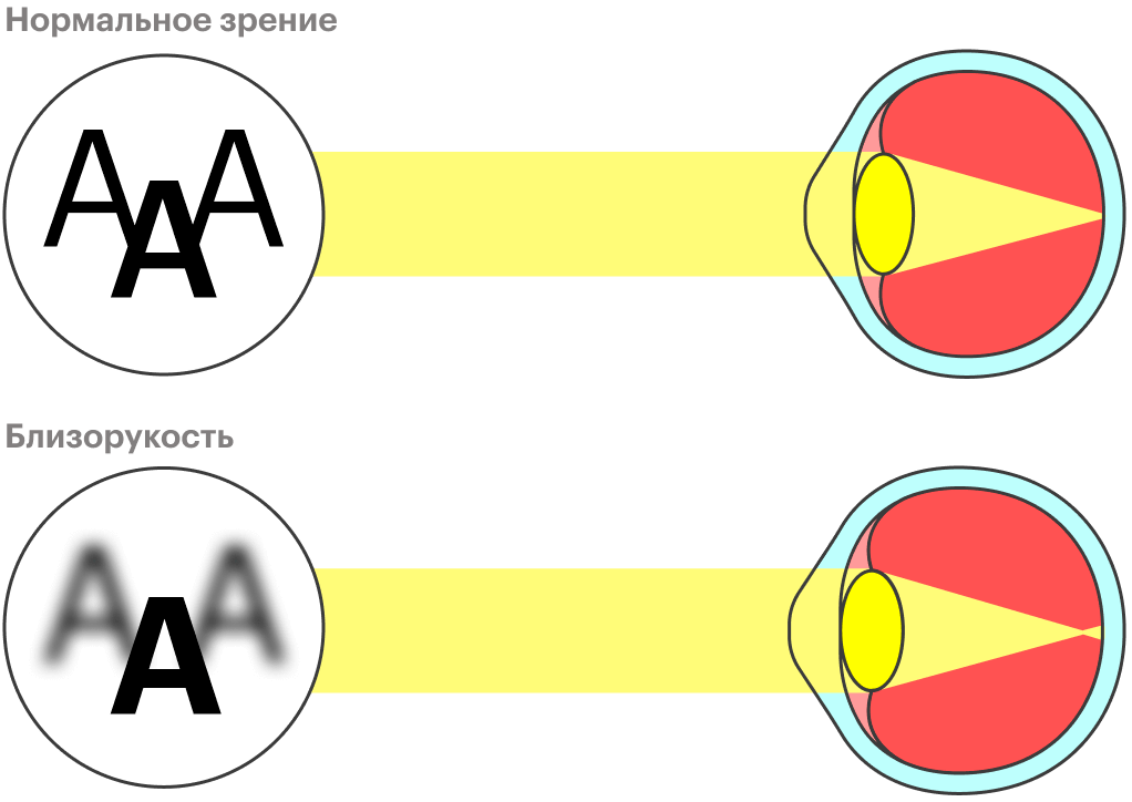 Глазное яблоко у людей с нормальным зрением ровно такой длины, чтобы фокусировать свет на сетчатке. У людей с близорукостью: свет фокусируется за сетчаткой, так что изображение вдали получается размытым
