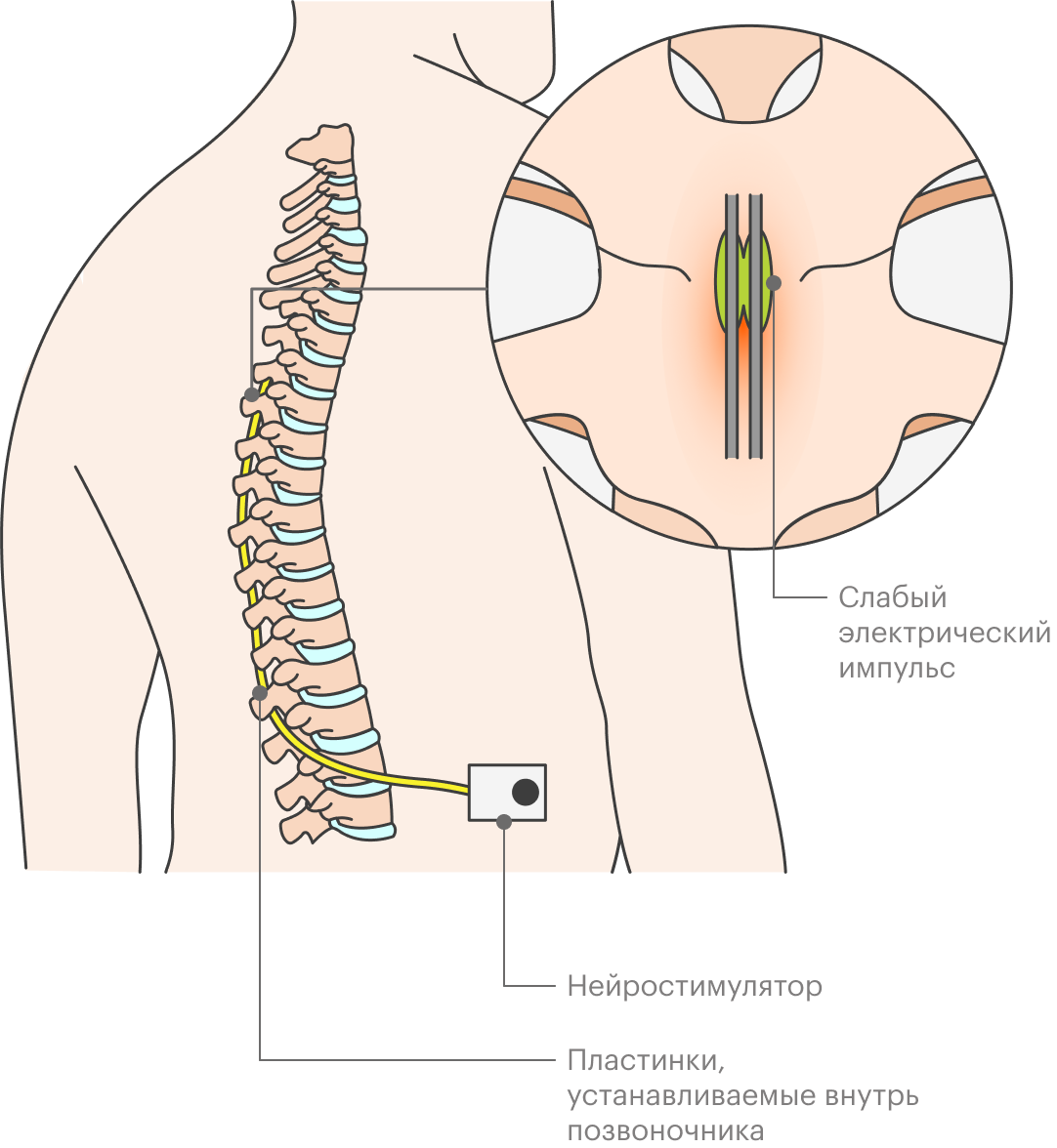 Электростимуляция спинного мозга позволяет лечить хронические болевые синдромы, с которыми не справиться другими способами