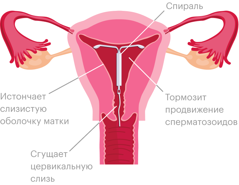 После установки спирали