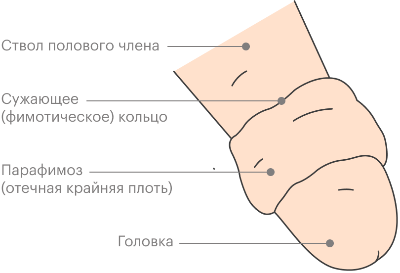 Баланопостит У Мальчика Фото