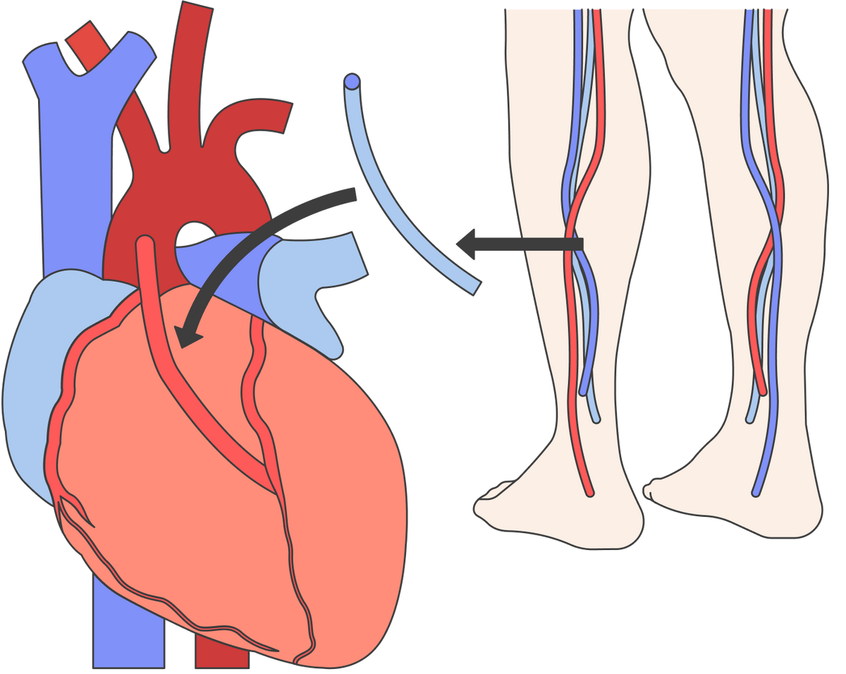 Для&nbsp;шунтирования берут искусственную трубочку или кусочек менее важного сосуда, например вены ноги, и накладывают так, чтобы кровь шла в обход сужения артерии