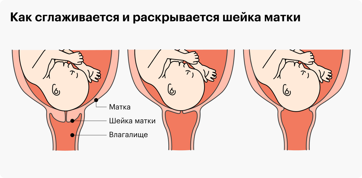 Как расширяется шейка матки в зависимости от стадии родов. На первом изображении она закрыта, то&nbsp;есть роды еще не начались. На втором открыта на один сантиметр, или палец, то&nbsp;есть роды начались. На третьем — открыта полностью