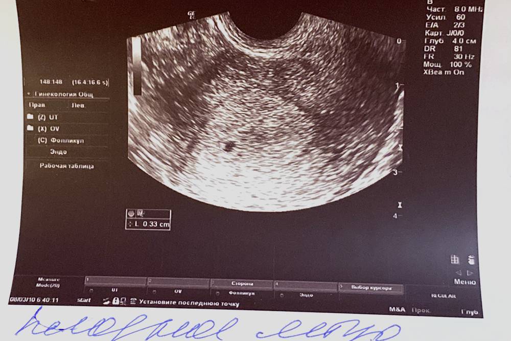 Примерно так выглядит беременность в пять недель на снимке УЗИ: пока эмбрион мало походит на человека, но можно разглядеть плодное яйцо, а иногда и пульсацию на месте будущего сердца