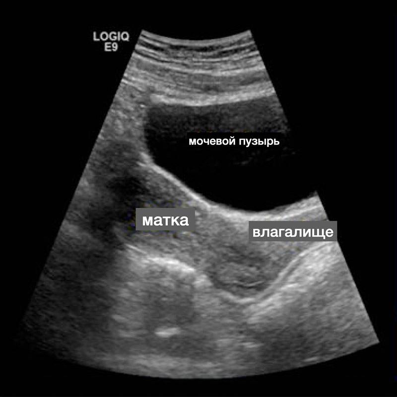 Разница узи. УЗИ матки ьран абдоминально. УЗИ малый таз трансабдоминально. УЗИ придатков трансабдоминальное что это. Матка УЗИ трансабдомигальнл.