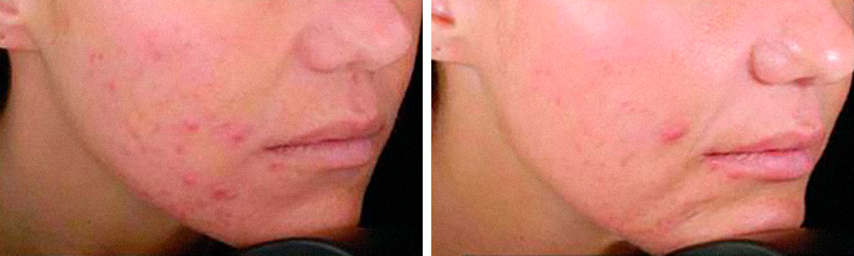 Фото пациентки с акне до и после четырех сессий лечения кожи пилингом