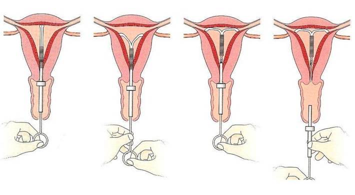 Фото Спирали Против Беременности В Матке