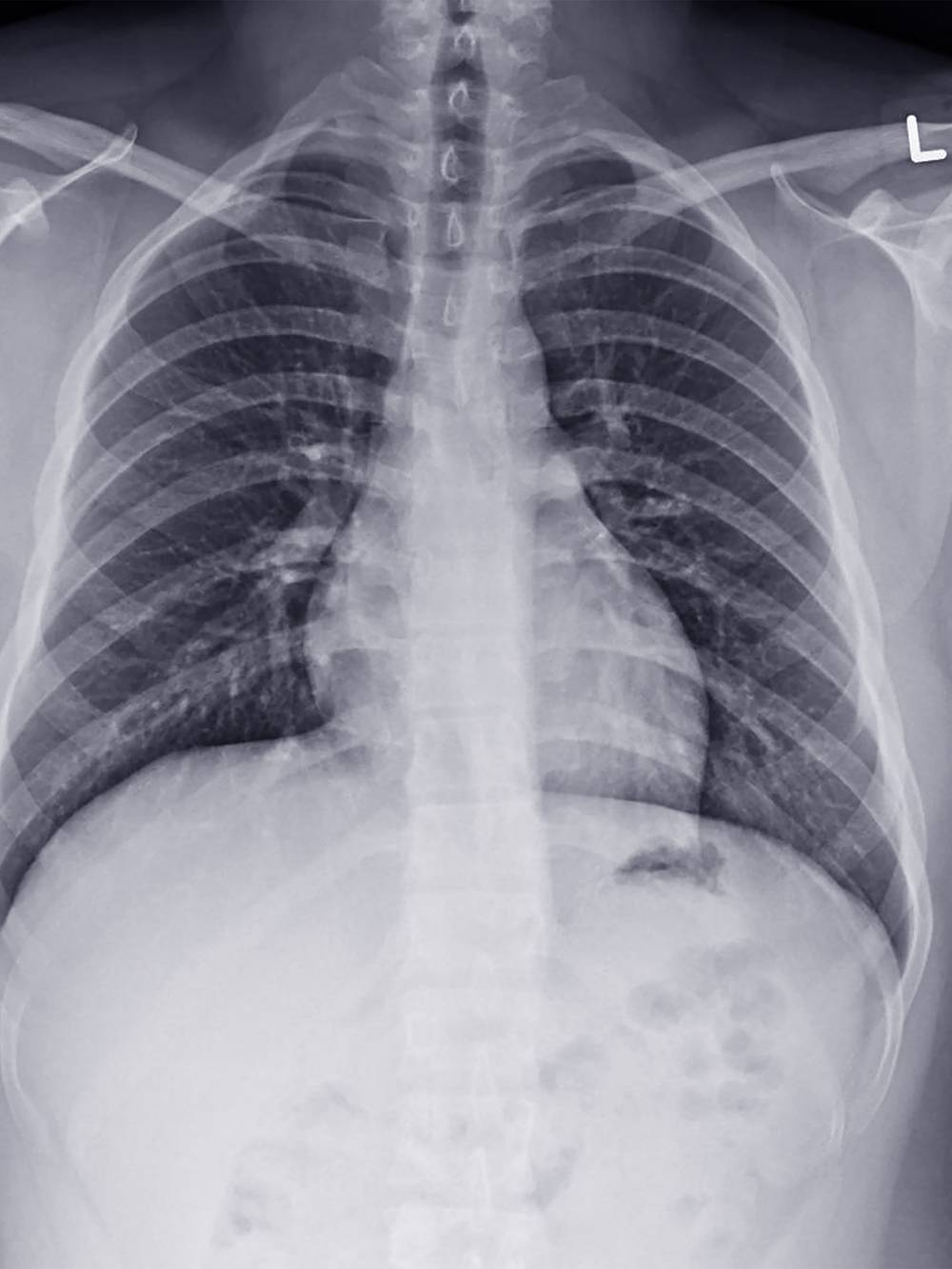 Рентгенограмма грудной клетки. Изображение получается более отчетливым, чем на флюорограмме. Фото: Peter Porrini / Shutterstock