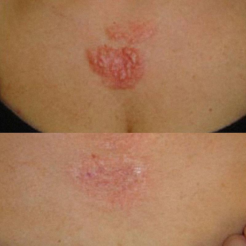 Фото до и после лечения рубцов
