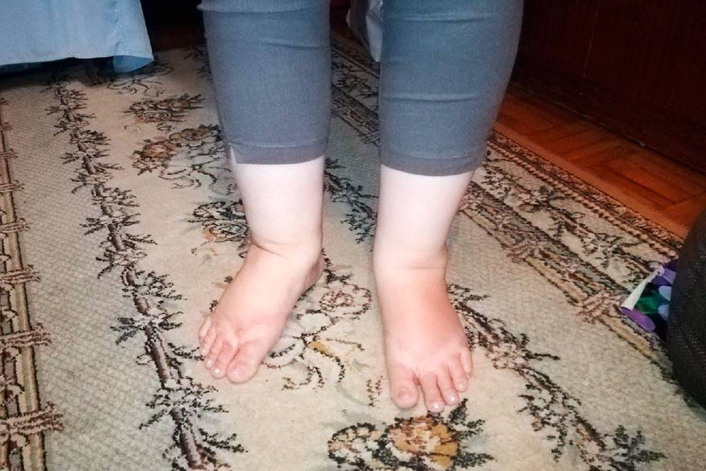 Как выглядит лимфостаз. Мамины ноги вне периодов обострения лимфедемы — стопы выглядят одинаковыми