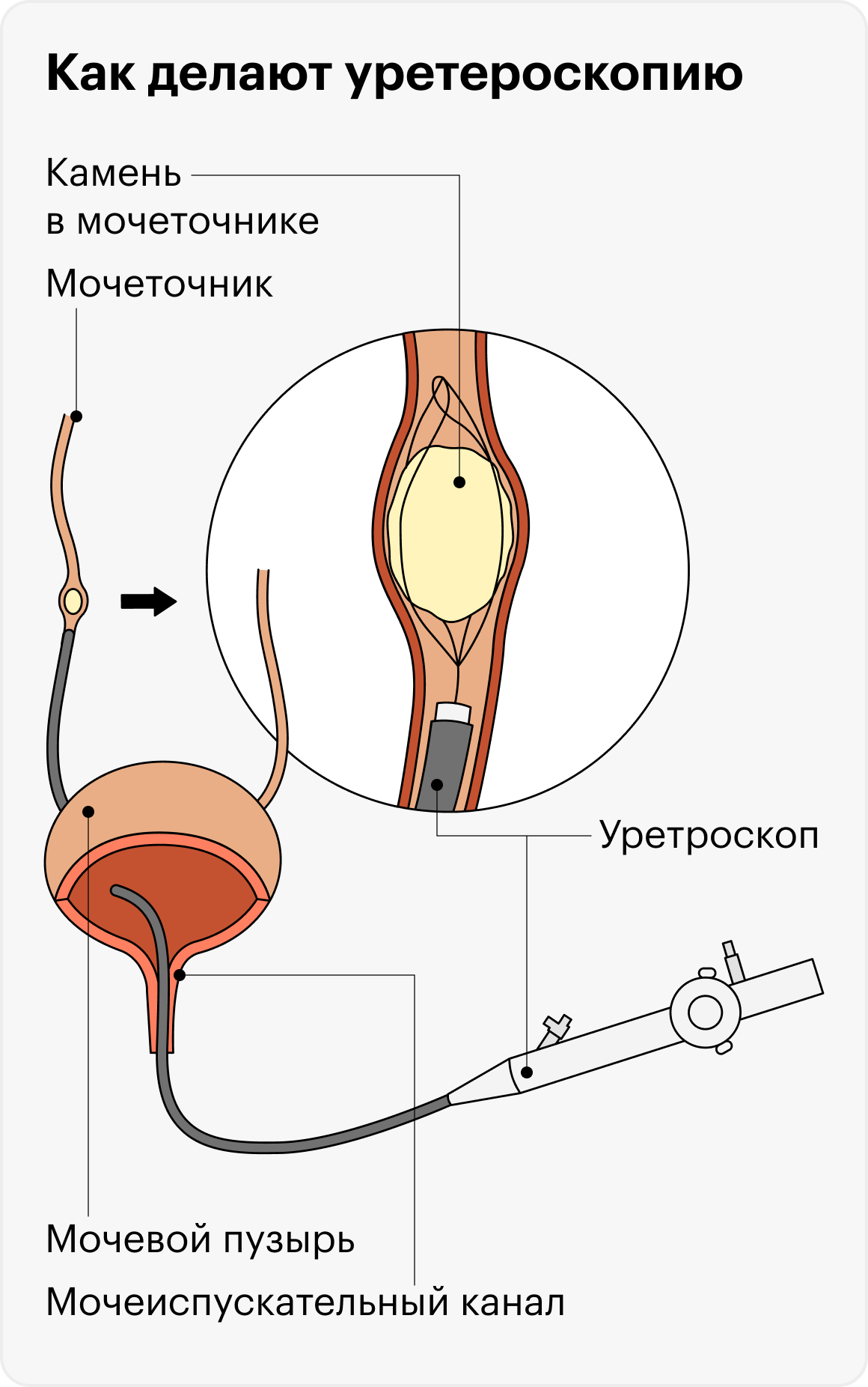 При&nbsp;уретероскопии камень удаляют или разрушают с помощью эндоскопического прибора, который вводят через мочеиспускательный канал
