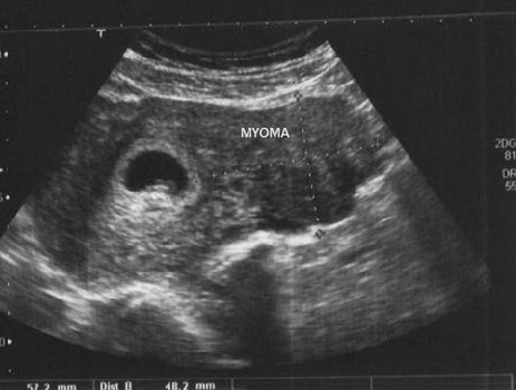 УЗИ-снимок миомы при&nbsp;беременности в&nbsp;восемь недель. Темное пятно слева от&nbsp;подписи «миома» — плодное яйцо. Источник