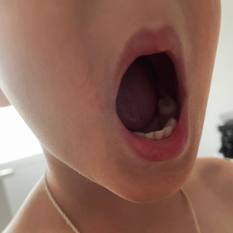 Так выглядит рот ребенка после удаления жевательного зуба