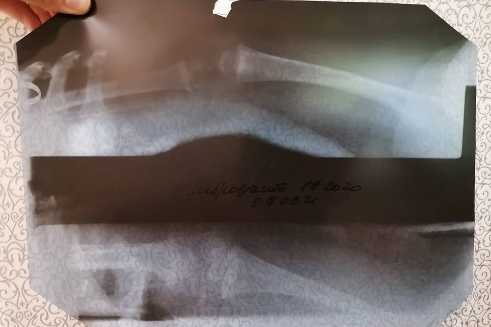 Повторный рентген через неделю после перелома