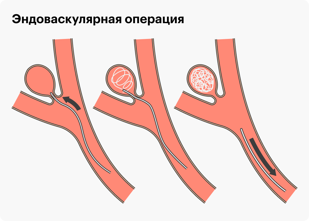 В случае эндоваскулярной операции в аневризму помещают тоненькую нить, которая перекрывает кровоток