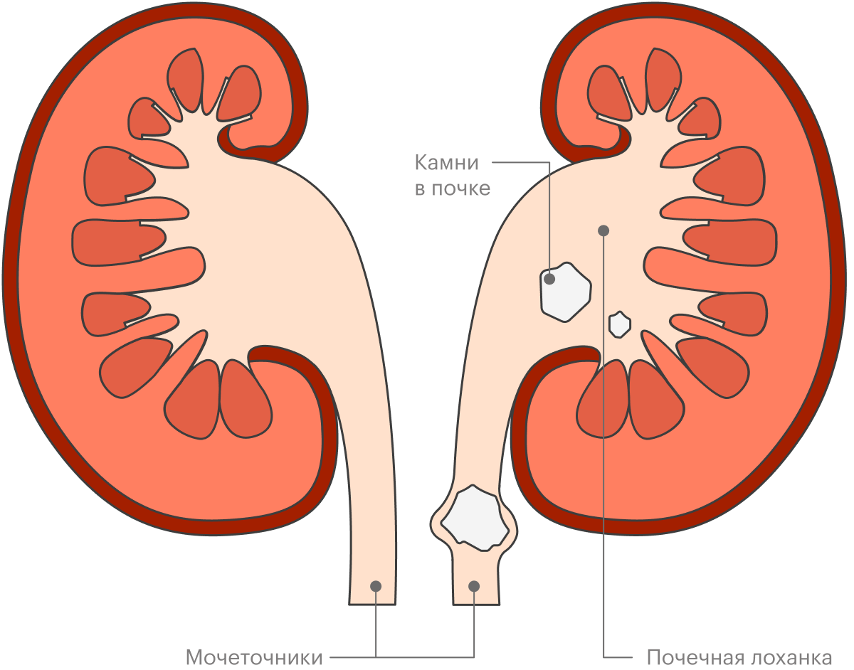 Лечение Камней В Почках Фото