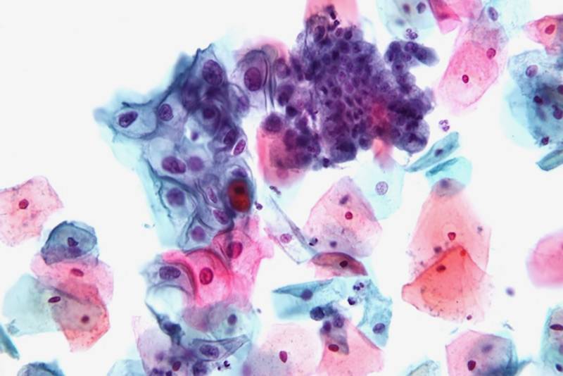 Так выглядит мазок по Папаниколау под&nbsp;микроскопом. Сине-фиолетовые клетки в середине слева — аномальные, потенциально могут быть предраковыми. Источник: Scienceline