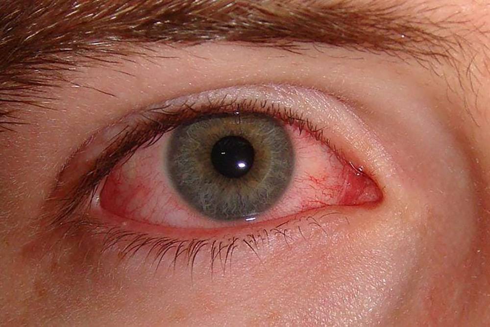 При&nbsp;вирусном конъюнктивите, как на иллюстрации, обычно розовеют белки обоих глаз. А при&nbsp;бактериальном из уголка глаза еще и выделятся&nbsp;бы гной. Источник:&nbsp;medscape.com