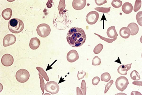 Серповидные эритроциты при&nbsp;одной из наследственных анемий — серповидноклеточной. Источник: uptodate.com