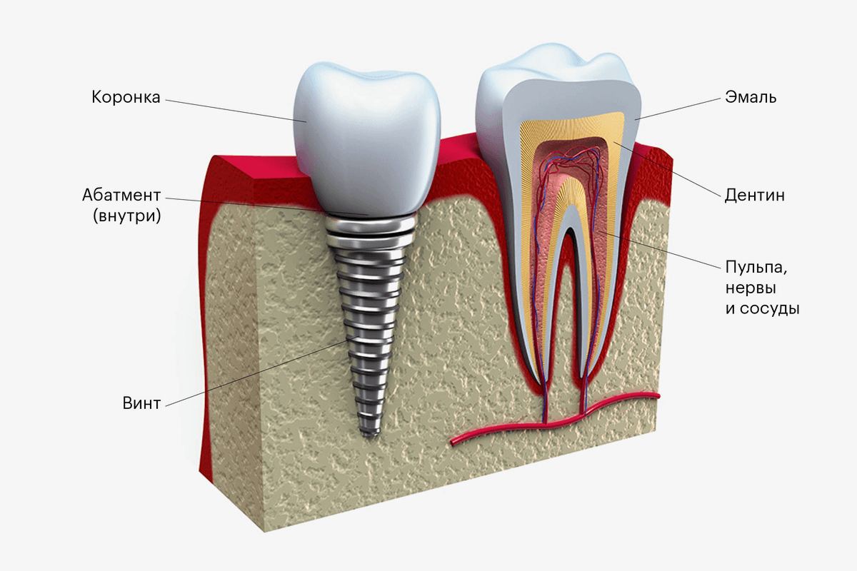 Имплантат похож на схематичный зуб. Главное отличие — внутри коронки нет кровеносных сосудов и нервов, а вместо живого корня — металлический винт
