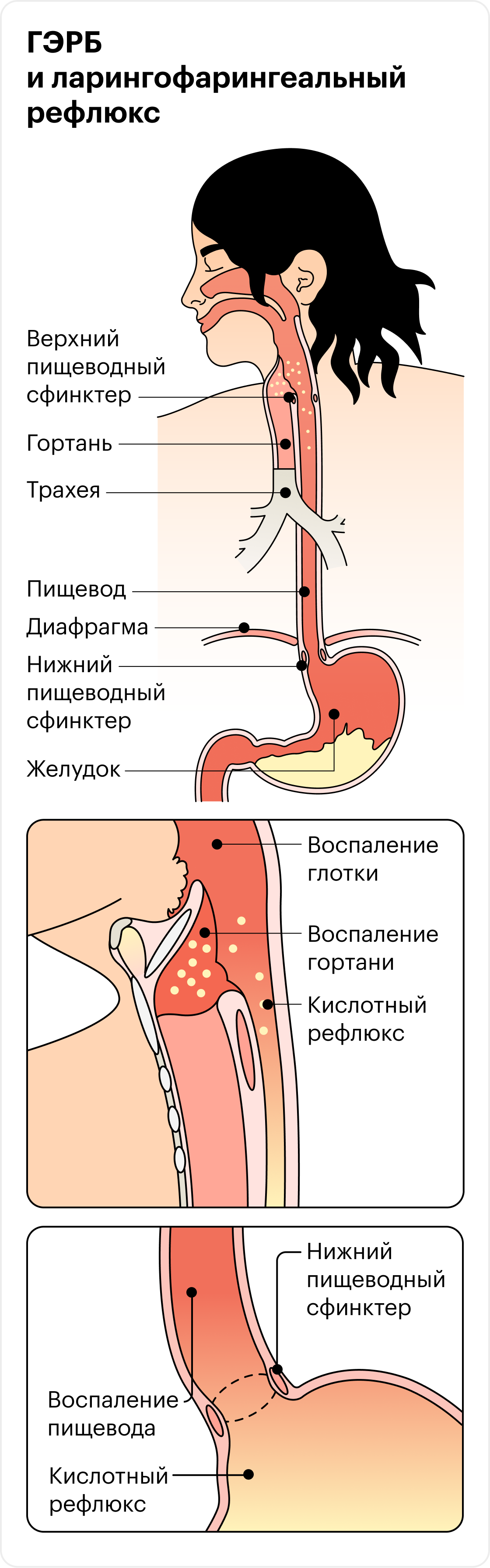 При ГЭРБ кислый желудочный сок забрасывается из желудка в пищевод, а у некоторых поднимается выше и попадает в гортань и глотку