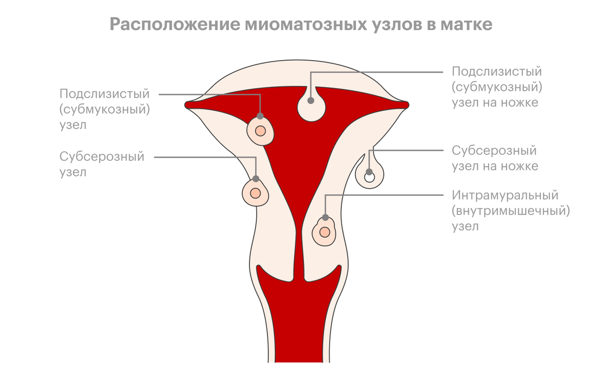 Как Выглядит Миома Фото