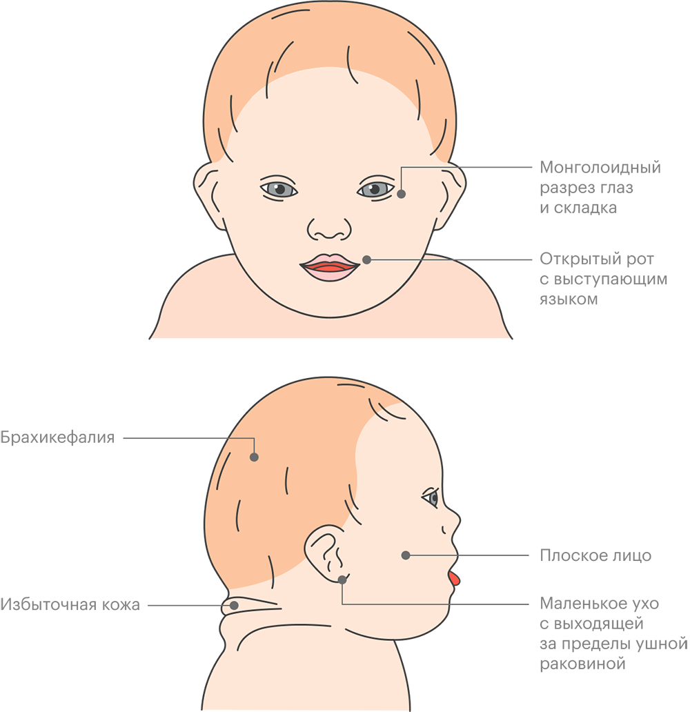 Большинству людей с синдромом Дауна присущи такие черты: плоское лицо, короткая шея и нос, маленькие уши, открытый рот. У каждого человека те или&nbsp;иные черты будут выражены в разной степени