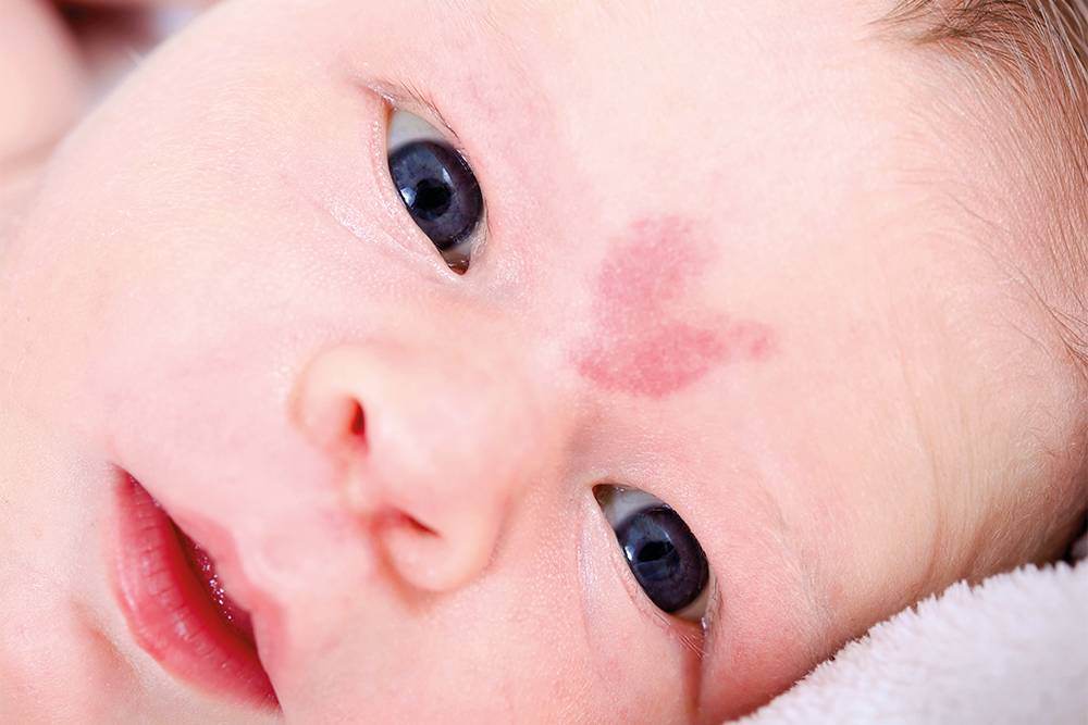 Сосудистое пятно на лбу. Такие бывают у 25—40% новорожденных и проходят в возрасте от трех до пяти лет. Источник:&nbsp;zandyz&nbsp;/ Shutterstock